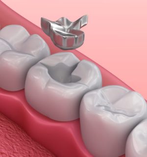 dental amalgam removal from tooth